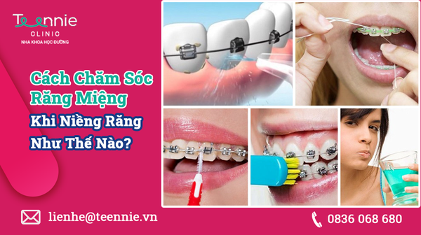 cach cham soc rang mieng khi nieng rang aaf1e9787f3448a9ab2a03814f079a7c grande