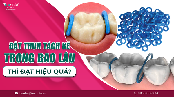 dat thun tach ke trong bao lau thi dat ket qua aff15f17ceb44762adc74407eaf937f0 grande