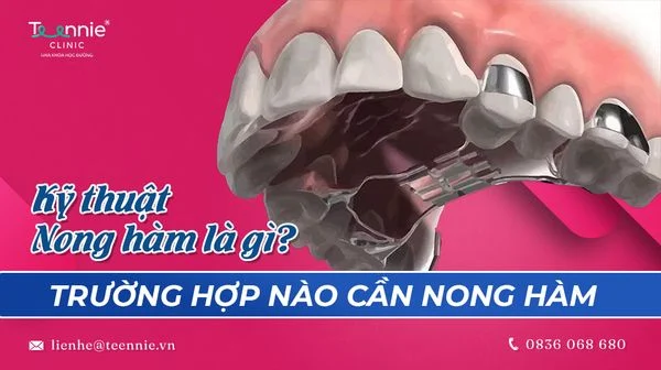 ky thuat nong ham la gi truong hop nao can nong ham fe0d3a6a07284cb7a968f331091f3afc grande