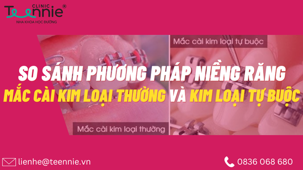 mac cai kim loai thuong va kim loai tu buoc 412f88752c2f4d9fb61f02f0e5640a0e grande