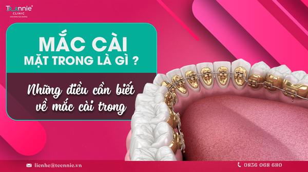 mac cai mat trong la gi nhung dieu can biet ve mac cai trong 40b26afb025b421c9596d1e3f9868314 grande