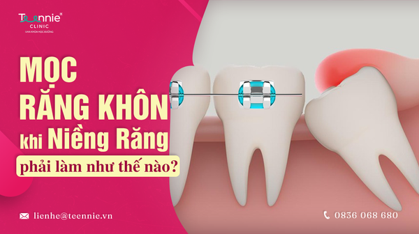 moc rang khon khi nieng rang phai lam nhu the nao 84feb2073f3b4dcca19280776ae586a2 grande