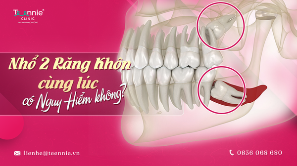 nho 2 rang khon cung luc co nguy hiem khong ba58c1e28a6b4a84a597fc74534d6ad5 grande