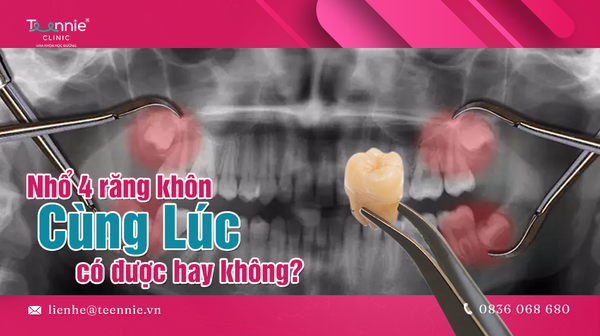 nho 4 rang khon cung luc co duoc hay khong d0972e72bba04bff937a9b93bd9721ca grande