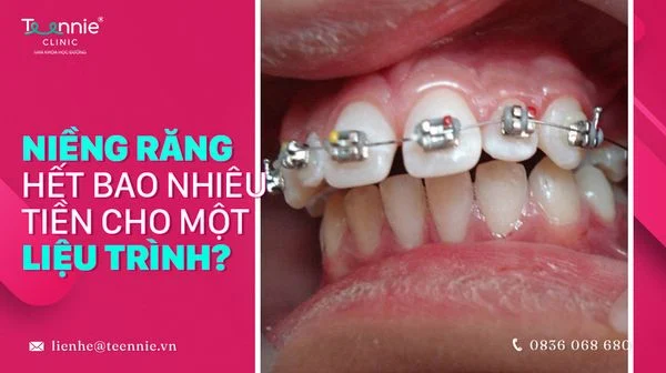nieng rang het bao nhieu tien cho mot lieu trinh bia a94cccc7e84b442fbcb8b8ea55011f01 grande