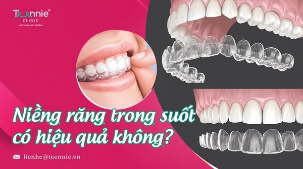 nieng rang trong suot co hieu qua khong b3e70470bd0b4f97babf29a06cdab1f1 grande