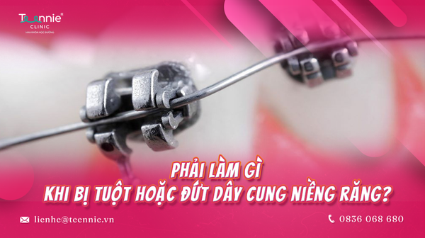 phai lam gi khi bi tuot hoac dut day cung nieng rang 9053ffe8d07543ba9f3041430bb81f84 grande