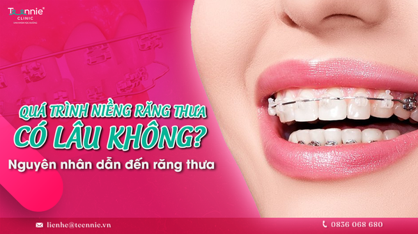 qua trinh nieng rang thua co lau khong nguyen nhan dan den rang thua 2d08b4fa54b5448ea6bdc6c3212817a0 grande