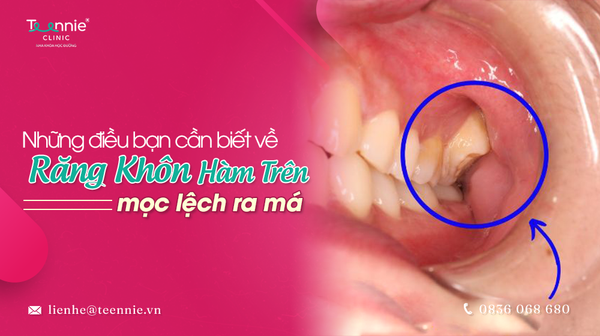 rang khon ham tren moc lech ra ma a0cbae5fe2fc4a42a770bbc560c71219 grande