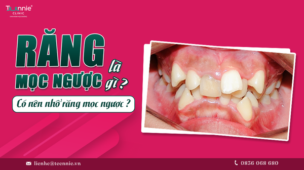 rang moc nguoc la gi co nen nho rang moc nguoc khong 8526efb4b0fb466da03c83236b246522 grande