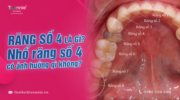 rang so 4 la gi nho rang so 4 co anh huong gi khong 9308a8c150494dafa09bdae4b93bb067 grande