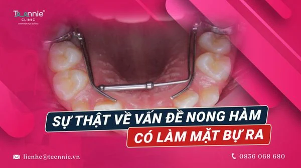 su that ve van de nong ham co lam mat bu ra 5d75cb4494304663bbb8217a46815c78 grande