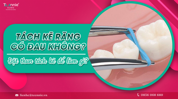tach ke rang co dau khong dat thun tach ke de lam gi 8913a26ad67344ecbca1f04b886c95ba grande