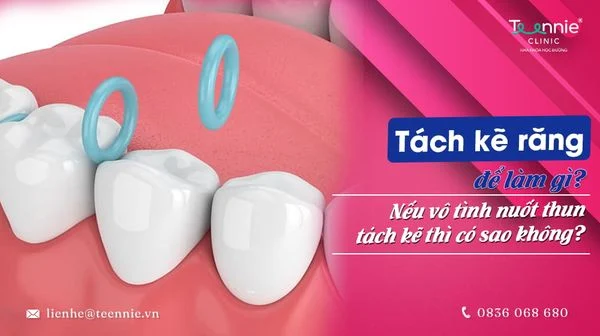 tach ke rang de lam gi neu vo tinh nuot thun tach ke thi co sao khong c09e6afbd30c4f40b9e29ef81d460b5b grande