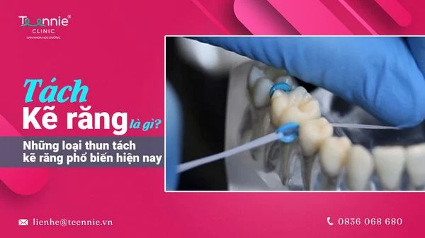 tach ke rang la gi nhung loai thun tach ke rang pho bien hien nay 2b6dc056e1c44ecca15ea37ab14de306 grande