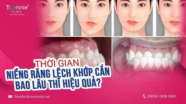 thoi gian nieng rang lech khop can bao lau thi hieu qua bia a366250e0dc0478bb15af87123a91c03 grande