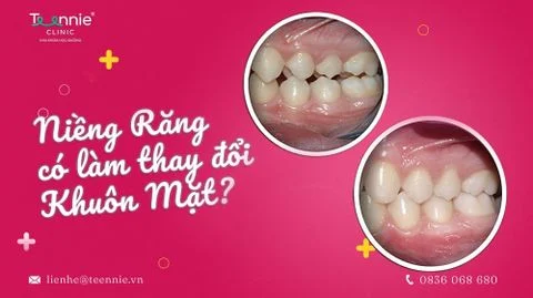 nieng rang lam thay doi mat 4d68979e61dd42b5a71daf17ec53f515 large