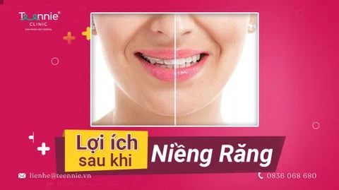 Những thay đổi bạn không thể ngờ sau khi niềng răng