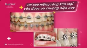 Tại sao niềng răng kim loại vẫn được ưa chuộng hiện nay