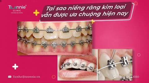 Tại sao niềng răng kim loại vẫn được ưa chuộng hiện nay