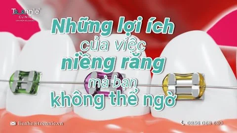 nhung loi ich cua viec nieng rang bia 13c5935aea6348bb861fab523893aa44 large
