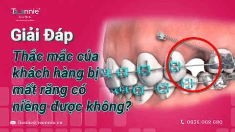 bi mat rang co nieng duoc khong bia 634ee59feac94339b1ac69b833088f1f large