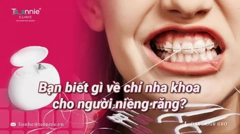 chi nha khoa cho nguoi nieng rang bia 6b2efbb536804c75ae3f99e0f543a09c large