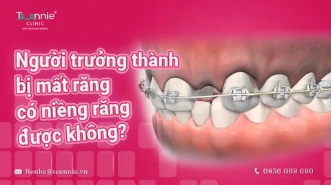 mat rang co nieng rang duoc khong bia e17bd80271f84785a9ef970b7b111751 large