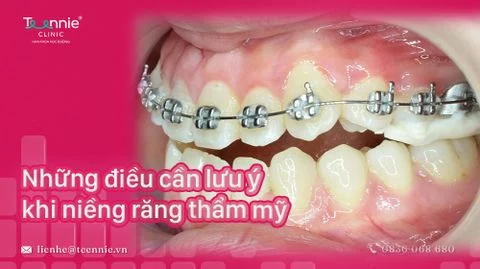 nhung dieu can luu y khi nieng rang bia a1515c51e66c4ff7a653c0c7becbfb91 large