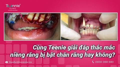 nieng rang bi bat chan rang hay khong bia ccdb7fc943c9444e938adb512bb5373c large