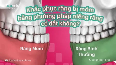 nieng rang co dat khong khi khac phuc rang mom bia 251c4474ede24b338fee6d97c7626c42 large