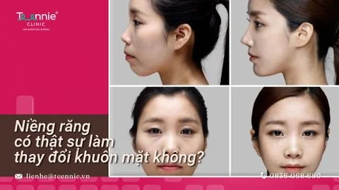 nieng rang giup mat thon gon hay khong bia 795991c09b564528b43d145a89ebae29 large