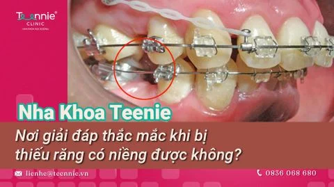 thieu rang nieng duoc khong bia 85e478fe691e4af9879b7060c9e6fcf3 large