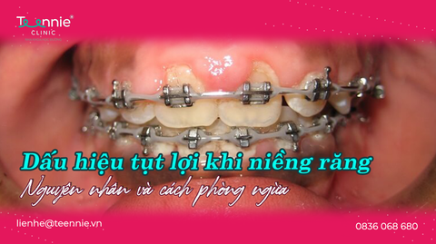 dau hieu tut loi khi nieng rang bia 3f401a25e4324249ba7621832e4b1bd0 large