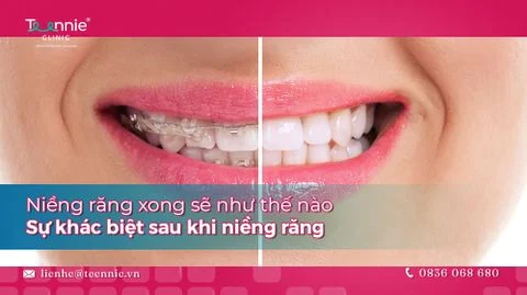 nieng rang xong se nhu the nao bia 95317cc71f444adbad52e0584ec6e7e9 large