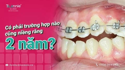 co phai truong hop nao cung nieng rang 2 nam bia 65c3c47b78624c80b173c40d46bd5eec large