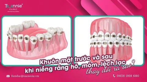 khuon mat truoc va sau khi nieng rang ho bia 8e7936f55c0048d9a0208746bbd5b900 large