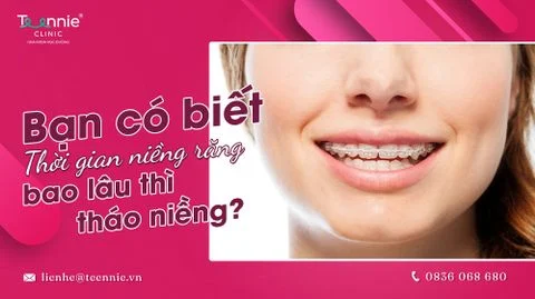 Bạn có biết thời gian niềng răng bao lâu thì tháo niềng?