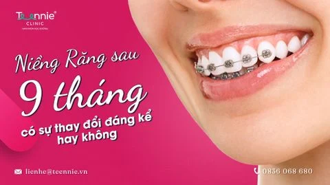 nieng rang sau 9 thang da co su thay doi bia 2d0bcc0820db445e82b26592a4c36a9e large