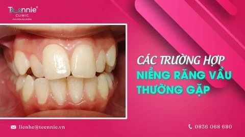 cac truong hop nieng rang vau tuong gap bia 2a5840de08a9449eaf4f9f0b9e23a152 large