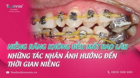 Niềng răng không đều mất bao lâu - Những tác nhân ảnh hưởng đến thời gian niềng