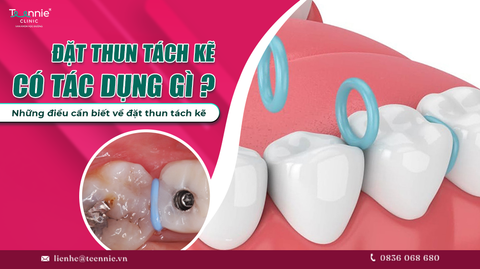 at thun tach ke co tac dung gi nhung dieu can biet ve dat thun tach ke d429bc1dc04345268eaaa66d665fe6f6 large