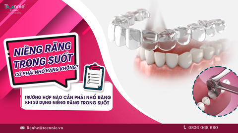 ong truong hop nao can phai nho rang khi su dung nieng rang trong suot d8eb608ff175403ab41329f542a1892a large