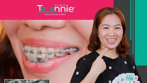 30 tuoi co nen nieng rang khong thumbnail eab3516fa4fb49078ba8b1801141283f large