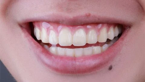 Mách bạn bí quyết giúp nướu răng luôn chắc khỏe!