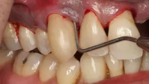 Chảy máu sau khi lấy cao răng, coi chừng ung thư máu!