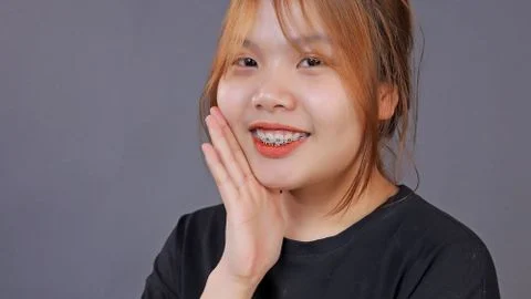 Khớp cắn sâu là gì? Niềng răng được không?