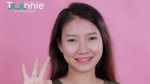 Mới niềng răng nên kiêng những loại thực phẩm nào?