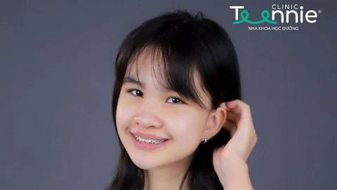 Niềng răng khểnh cần thời gian bao lâu? Cần lưu ý gì?