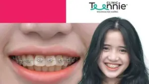 Niềng răng mắc cài sứ cần lưu ý những gì?